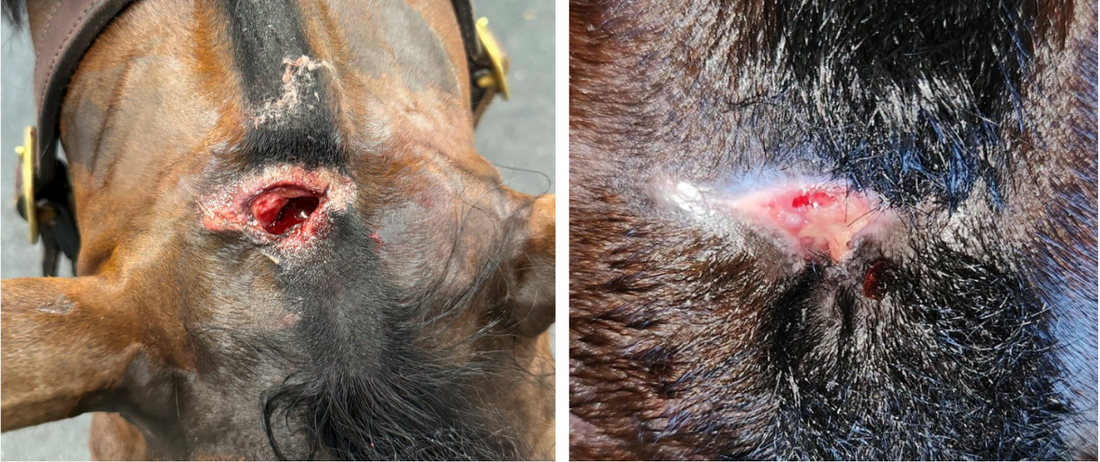 Poll Puncture Managed with Regenaflex-M