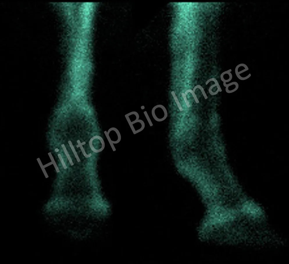 <p>Nuclear Scintigraphy</p>